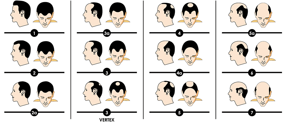 Hamilton-Norwood Scale