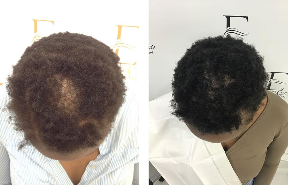 PRP_before_after