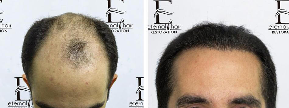 Male Patients - Eternal Hair