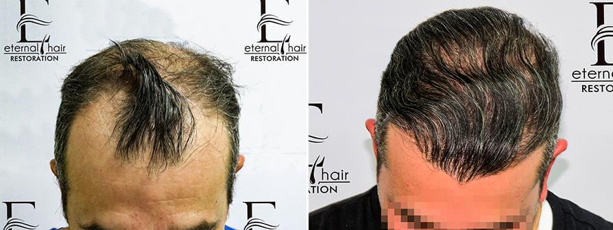 Before and After hair treatment